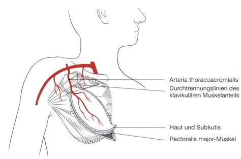 pectoralis major lappen|Wiederherstellungschirurgie in Mundhöhle und Oropharynx mit。